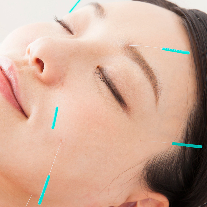 女性施術者勤務の美容鍼専門店